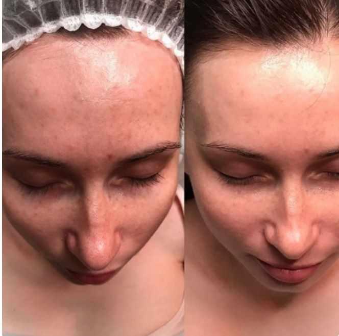 Молочный пилинг (natur.cosmetica)